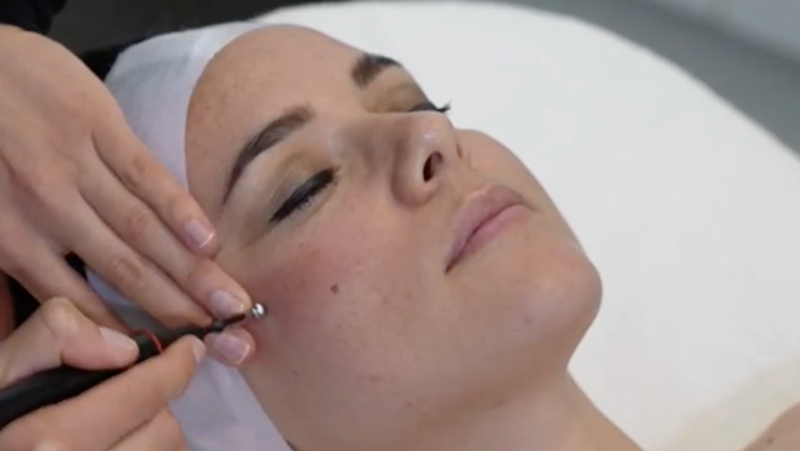 teslamed ionstream behandeling gelaat 
