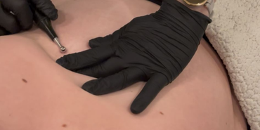 TRANSFORM Summer Proof – Huid verstevigen zonder snijden in 3 weken